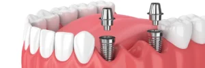 Implantaten