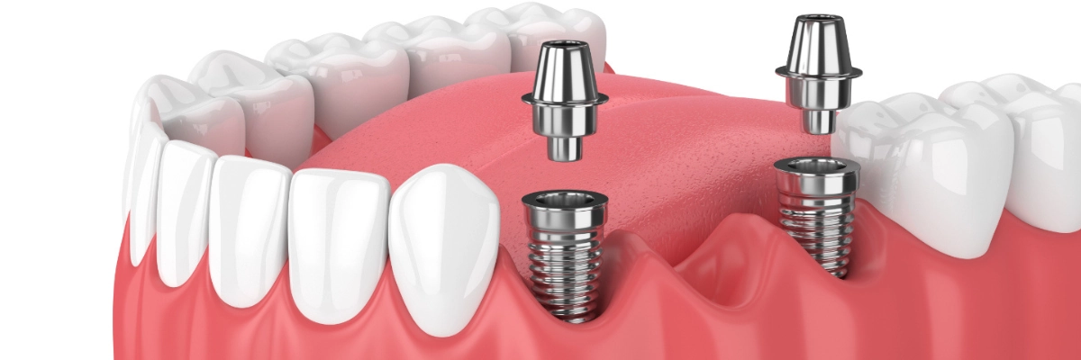 Implantaten